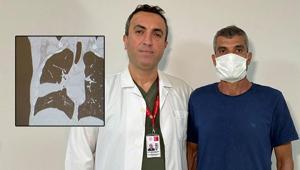 Hastanın akciğerinden kemik çıktı Kemiği seven biriyim, şaşırtmadı