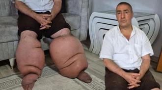 15 yıldır fil hastalığıyla mücadele ediyor: 'Eşim sadece rahat bir ayakkabı giysin'