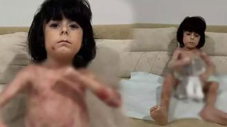 Yaraları tüm vücudunu sardı! 4 yıldır mücadele ediyor: Çaresiz durumda