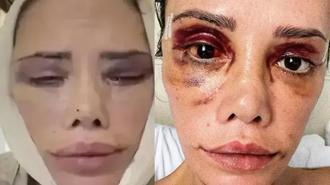 Yüz nakli olan Survivor Didem Ceran son halini paylaştı! 'Hepinizden çok özür diliyorum'