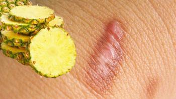 Son 10 yıldır en iyi tedavi! Ananastan yapıldı, yanığı 4 saat içinde iyileştiriyor