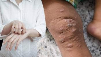 Uyuz bu ülkeyi de sardı! Uyarılar peş peşe: 'Yaşanan bir kabus'