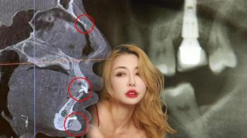 Ünlü modelden implant şoku! X-Ray'in alarmı hiç susmadı: 'Çiviler kafatasımda yürüyor'