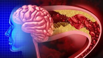 İnme sonrası hayata yeniden başlayanlar anlattı! 'Milattan önce ve sonrası gibi'