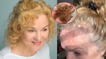 12 kilo verdi saçları avuç avuç döküldü! Kökleri küçültüyormuş: 'Etkisi uzun'