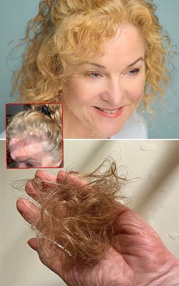 12 kilo verdi saçları avuç avuç döküldü! Kökleri küçültüyormuş: 'Etkisi uzun'