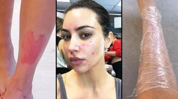 Kim Kardashian sedef hastalığını böyle hafifletti! 'Yöntem işe yaradı'