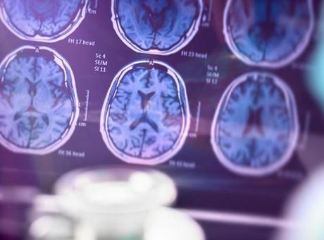 68442ae8651bfdc11b9b50bd SAĞLIK HABERLERİ: ALZHEIMER HASTALIĞINI ERKEN TEŞHİS EDEN KAN TESTİ