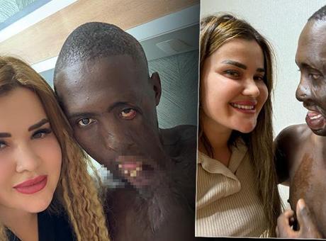68723523280d2d4b642c3c9e Dudağı omzuna yapışık halde Türkiye'ye geldi! Değişimi dünyaya umut oldu