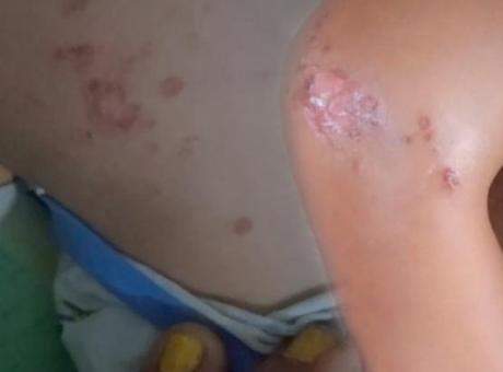687bb60d407805e46c03c053 Serinlemek için girdi, yanıkla çıktı! Denizde enfeksiyon paniği: 'Buradan vücuda giriyor'