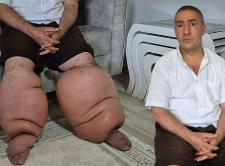 688cab47a24008c540a89cf8 15 yıldır fil hastalığıyla mücadele ediyor: 'Eşim sadece rahat bir ayakkabı giysin'