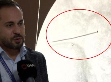 6910383e36206bb89d50a99b Ağrıyla kıvranan 2 yaşındaki çocuk doktorları şoke etti! 'Ölümüyle sonuçlanabilirdi'