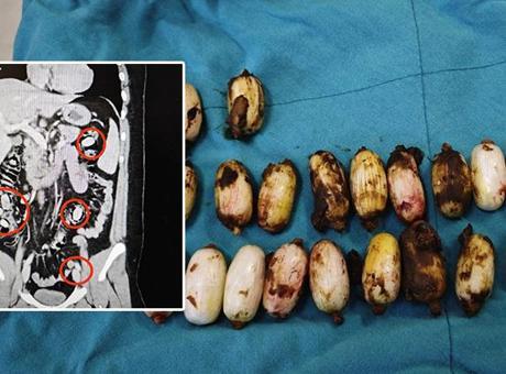 44 kapsül bonzaiyi midesinde saklamış! Cerrahi müdahale ile çıkarıldı