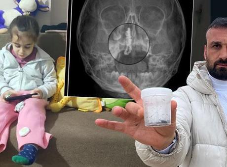 Rize’de akılalmaz olay! 5 yaşındaki Polen, 2 yıldır burnunda taşıyordu: Bu nasıl gözden kaçılabilir?