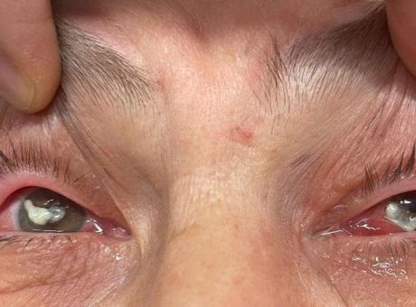 Kızının önerisiyle gözüne damlattı hayatı karardı! ‘Sosyal medyada çok yaygınlaşmaya başladı’