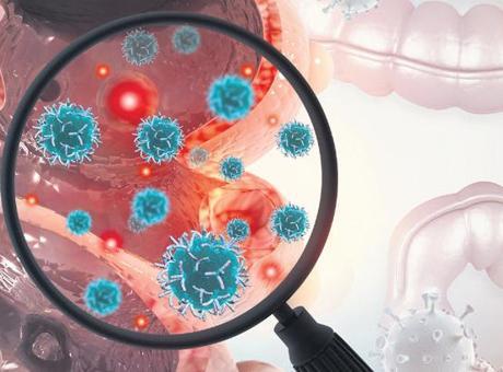 Türkiye’de her yıl 22 bin kişi kolon kanseri oluyor