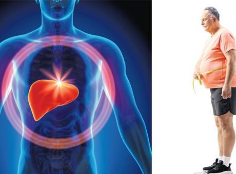 Küresel salgın: Karaciğer yağlanması