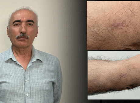 Kolundaki 1 santimetrelik yara aylarca geçmedi! Hastanede ge