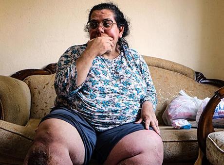 Fil hastası 3 çocuk annesi, tedavi olmak için yardım bekliyor: Yaralarda kurtlanma oluşuyor