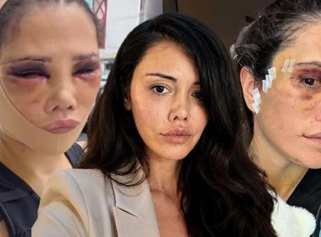 Yüzünü gerdirmişti! Didem Ceran ameliyatının 12. gününden paylaştı: Ağzım yamuk