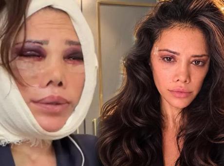 İki kez yüzünü gerdirdi! Didem Ceran’dan yeni estetik açıklaması