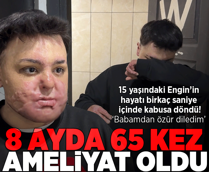 Hayatı birkaç saniye içinde kabusa döndü!15 yaşında 8 ayda 65 ameliyat geçirdi: 'Babamdan özür diledim'