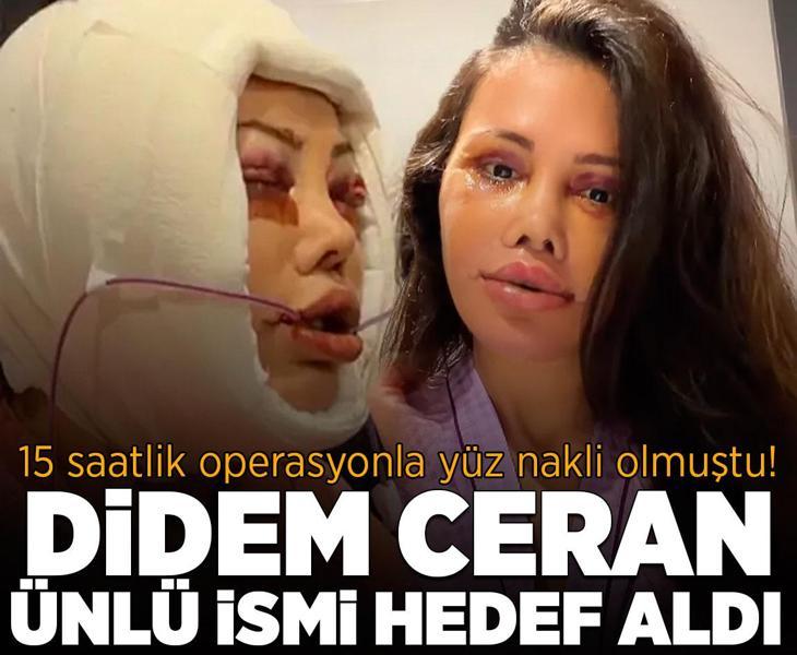 Didem Ceran 15 saatlik operasyonla yüz nakli olmuştu! Kendisini dünyaca ünlü yıldızla karşılaştırdı