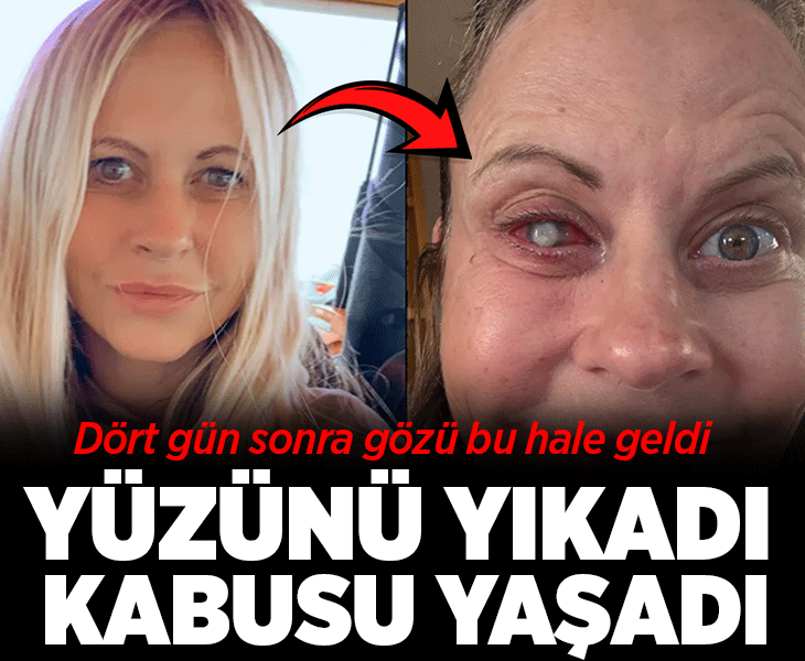 Yüzünü yıkamasıyla kabusu yaşadı! Parazit gözünü adeta yedi: 'Üç doğum bunun yanında rüya gibi kalır'
