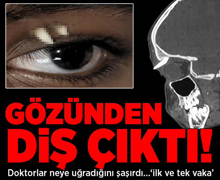 Doktorlar şaşkına döndü! Gözünden diş çıktı: &amp;#x27;İlk ve tek vaka&amp;#x27;