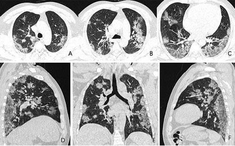 Akciğer tomografisinin Kovid-19 tanısında yeri