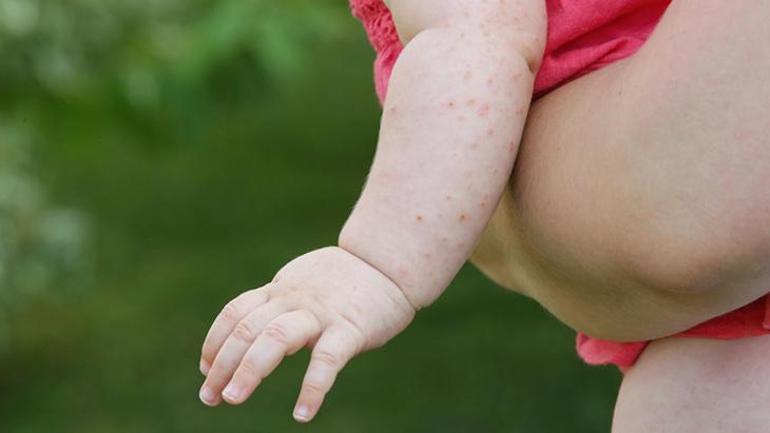 Bebeklerde viral döküntü neden olur