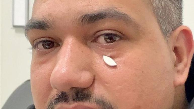 Vücudundaki metal parçayı 3 yıl sonra mıknatısla fark etti