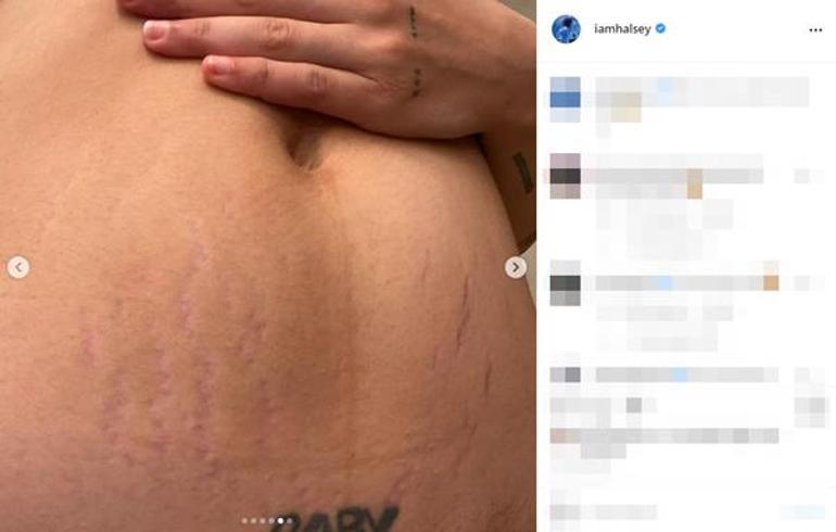 Halsey, doğum sonrası çatlaklarını paylaştı