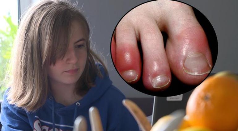 Kovid parmağı sendromu için bilim insanlarından yeni açıklama