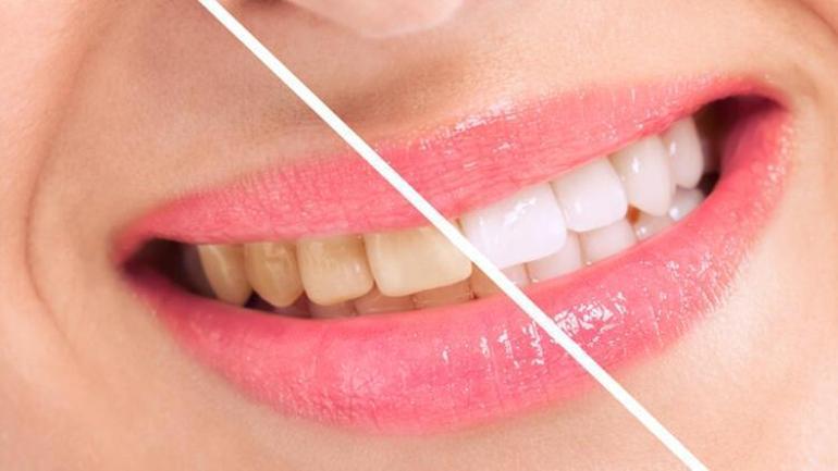 Bu maddeye dikkat Dişleri beyazlatmak yerine zarar veriyor