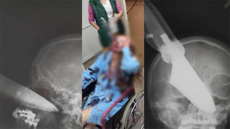 Burnunda 25 santimetrelik bıçakla hastaneye getirildi Kan dondurdu