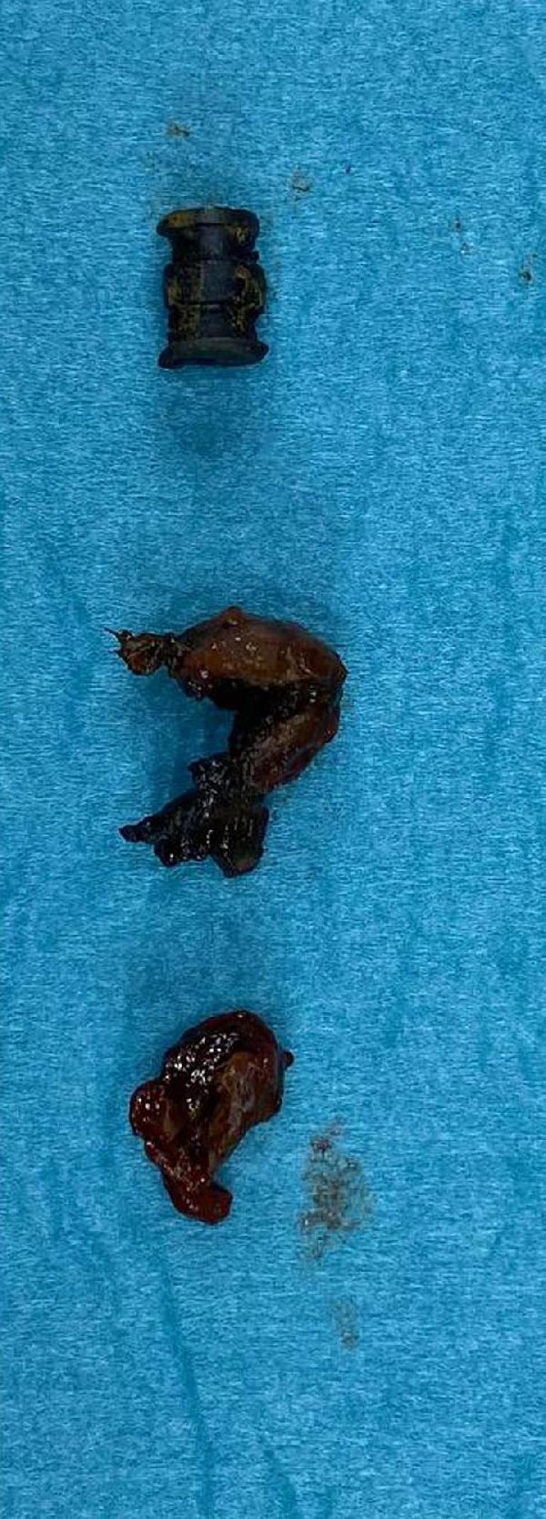 15 yıl yanağındaki metal parçayı fark etmedi Mıknatısın çektiğini gördük