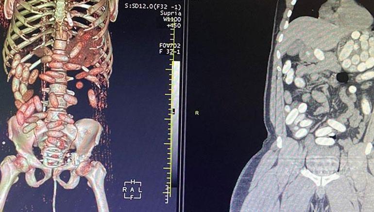 7 yolcunun midesinden 11 kilo kokain çıktı