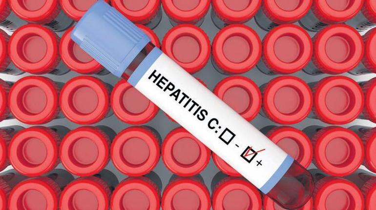 Hepatit C