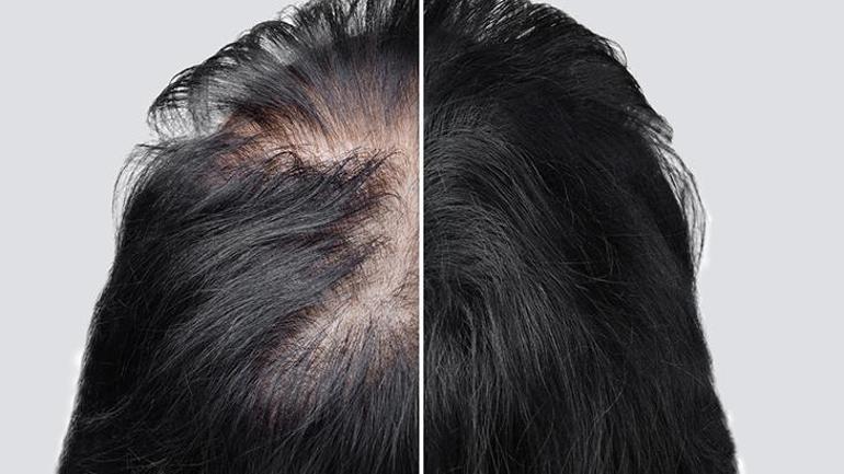 Oscar ödül törenine damga vuran hastalık: Alopesi areata nedir, tedavisi var mı