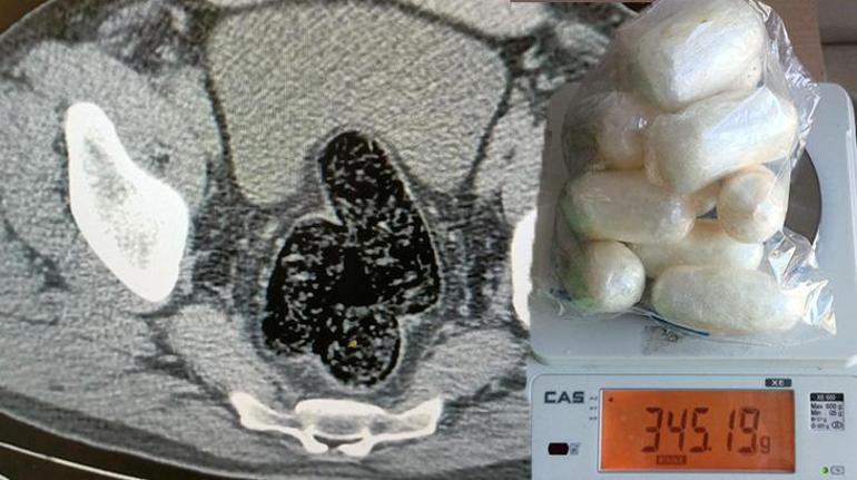 12 kapsül metamfetamin yuttu 355,36 gram uyuşturucuyla yakalandı