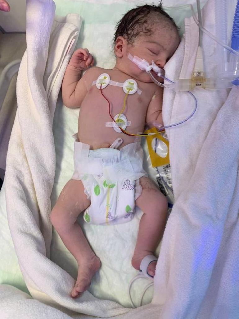 Organları göğüs kafesinde doğan Lena bebeğe hayat veren dokunuş