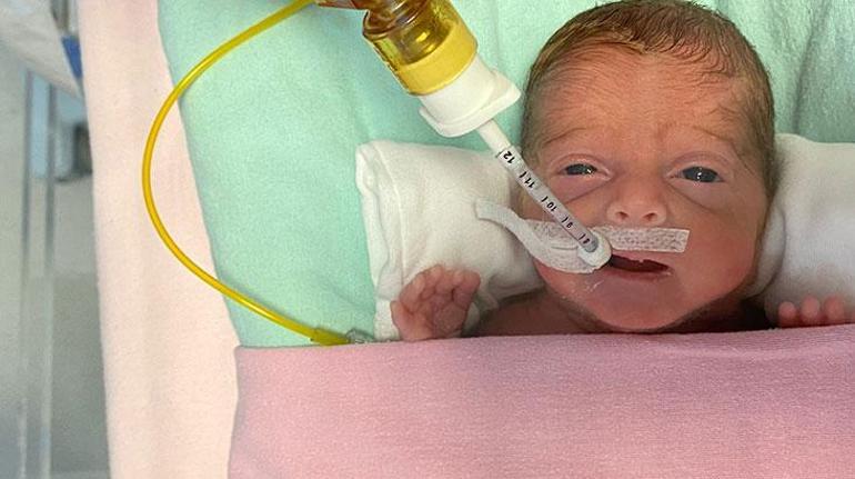 540 gramlık parmak bebek Rabiayı kök hücre tedavisi hayata bağladı