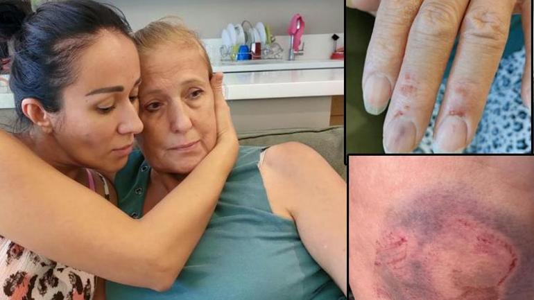 Antalyada şoke eden olay Rus kadın denizde caretta caretta tarafından kalçasından ısırıldı