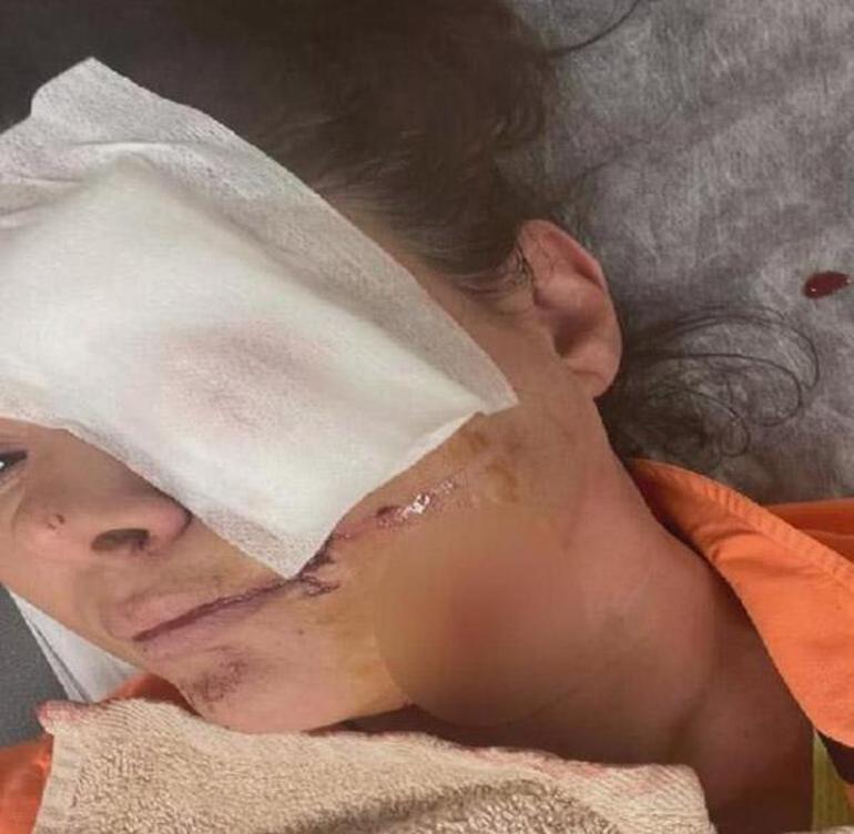 Tuğba Altıntop köpek saldırısına uğradı Yüzüne dikiş atıldı