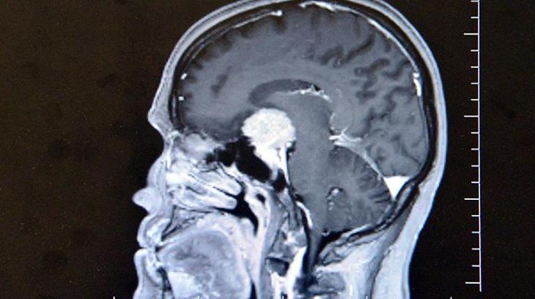 Beynindeki milyonda bir görülen tümör, ameliyatla burnundan çıkardı