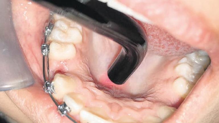 Hızlandırılmış ortodontik tedaviler