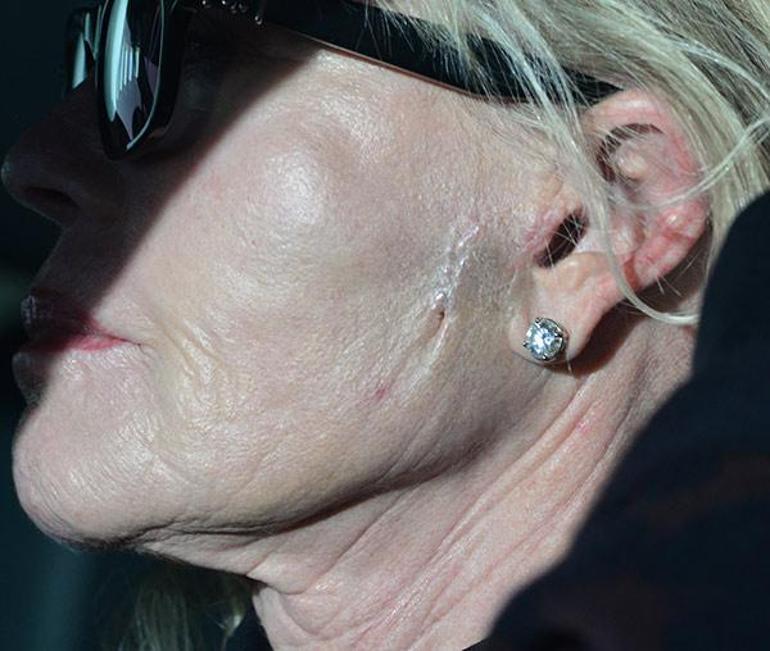 Kanseri yenen Melanie Griffithin yüzündeki yara izi korkuttu