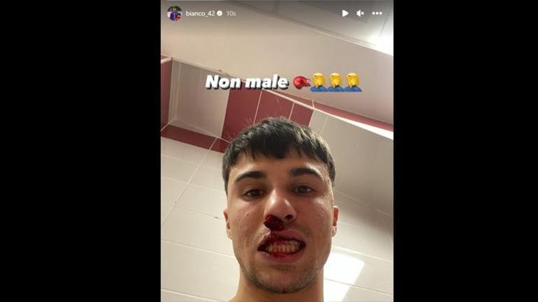 Sahaya atlayan taraftar İtalyan futbolcunun burnunu kırdı