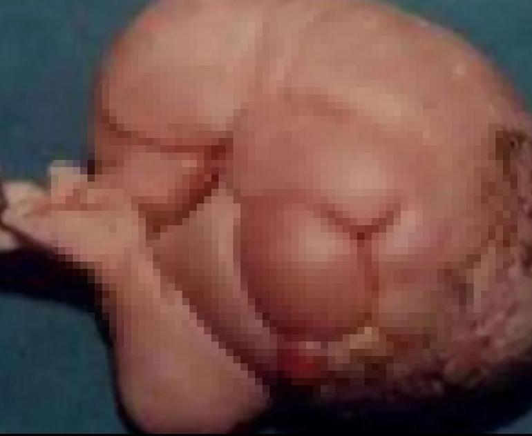 Tümör sandılar bebek çıktı Hamile adam vakası: 36 yıl taşıdı